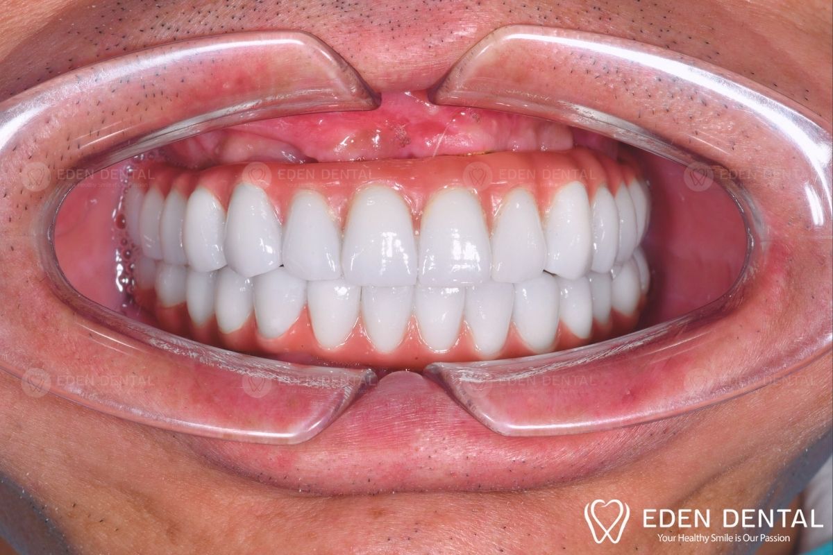 After All-on-4 Implants