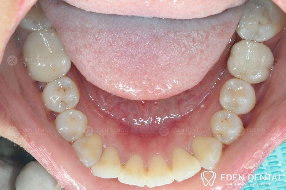 After Single Tooth Implant