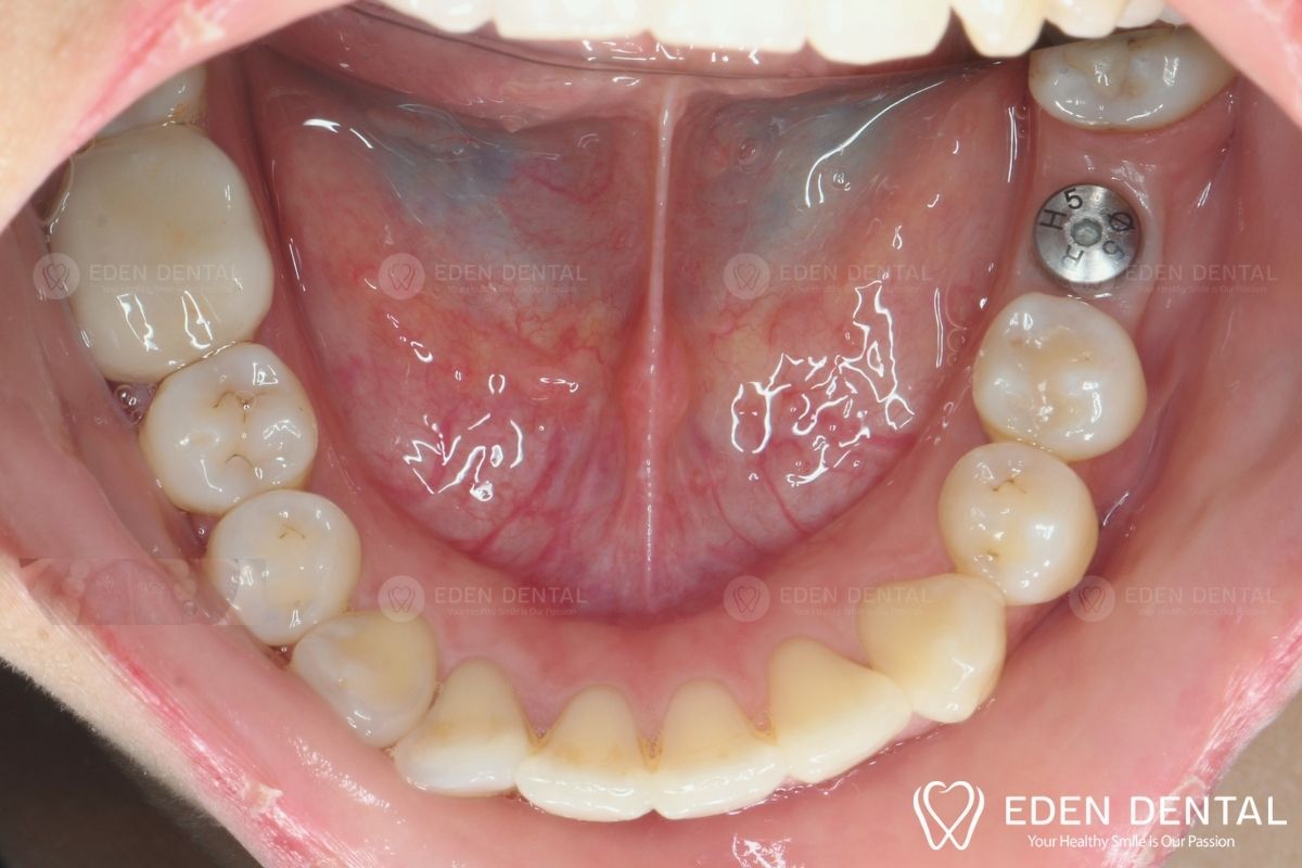 Before Single Tooth Implant