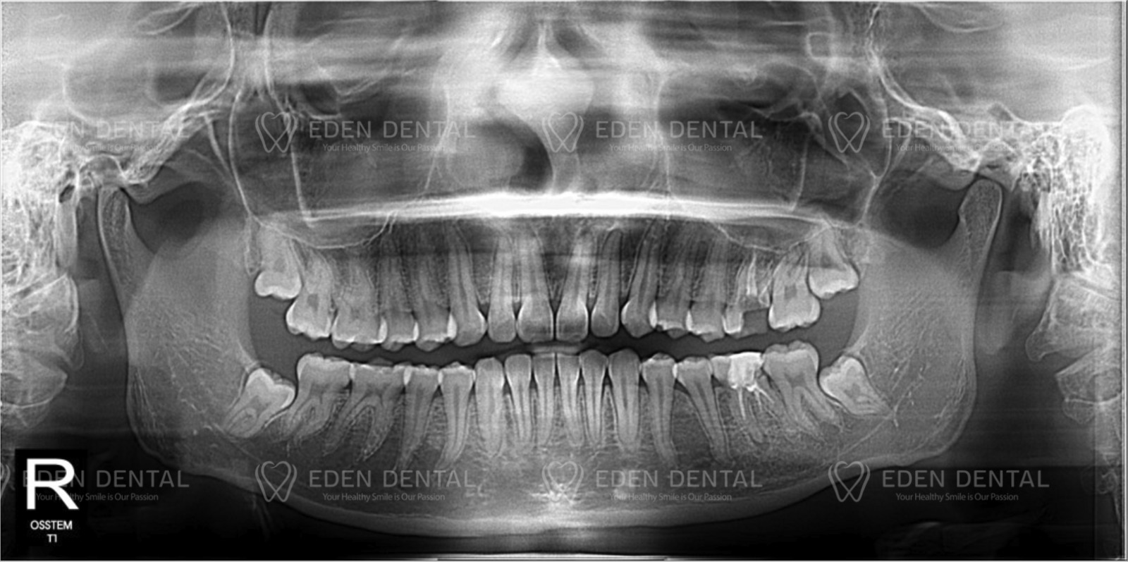 Before One Day Implant